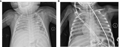 WU Polyomavirus Infection in Children With Acute Lower Respiratory Tract Infections in China, 2017 to 2019: Case Reports and Multicentre Epidemiological Survey